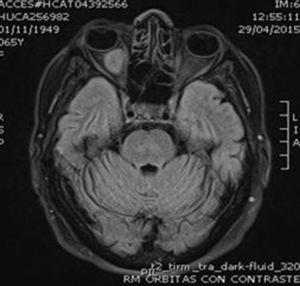 T1-weighted magnetic resonance imaging sequence. Hypoechoic lesion.