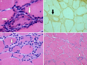 Image of the muscle biopsy: (A) There are muscle fibers with regenerative peripheral basophilic areas (hematoxylin–eosin stain ×63). (B) Muscle expression of the class I antigens of the human leukocyte antigen (HLA) system. (C) There is an endomysial lymphocyte cell infiltrate located in the (hematoxylin–eosin stain ×40). (D) Variability of the size of the muscle fibers and periendomysial (hematoxylin–eosin stain ×10).