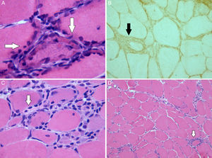 Image of the muscle biopsy: (A) There are muscle fibers with regenerative peripheral basophilic areas (hematoxylin–eosin stain ×63). (B) Muscle expression of the class I antigens of the human leukocyte antigen (HLA) system. (C) There is an endomysial lymphocyte cell infiltrate located in the (hematoxylin–eosin stain ×40). (D) Variability of the size of the muscle fibers and periendomysial (hematoxylin–eosin stain ×10).