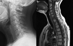 Osteolytic lesion of the anterosuperior segment of the vertebral body of C7 (a). Sagittal magnetic resonance T1-weighted image of the cervicothoracic spine (b). Diffuse abnormality of the bone marrow signal of vertebral body C7, with collapse and probable erosion of the superior vertebral endplate. Focal involvement of a similar signal intensity and involvement of the anterior half in vertebral bodies of thoracic T1 and T2. We observe the component of soft tissue aligned in front of vertebral bodies from C4 to C7. The signal pattern is compatible with substitution of normal bone marrow.