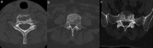 Computed tomography. Lytic and sclerotic lesions in vertebral bodies of the cervical (a), thoracic (b) and lumbosacral (c) spine.