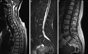 Sagittal T2-weighted image of cervicothoracic spine (a), which shows a diffusely heterogeneous bone marrow signal, with no focal areas of prominent signal in the bodies affected in the aforementioned figure. The focal collapse of superior vertebral endplate at C7 persists. Sagittal short tau inversion recovery (STIR) image of the thoracolumbar spine (b), which shows a homogeneously suppressed bone marrow signal, without the areas of edema described in the legend to Fig. 3(b). Sagittal T1-weighted image of thoracolumbar spine (c), showing a bone marrow signal that is diffusely heterogeneous regarding the predominant T1-weighted hyperintensity pattern, compatible with a predominance of fatty bone marrow in all the vertebral bodies. The focal collapse/and hernia in spongy tissue in the superior endplate of L4 persist as chronic aspects.