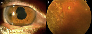 (A) Sequelae of anterior uveitis with tent-shaped peripheral anterior synechiae. (B) Multiple chorioretinal lesions in peripheral retina.