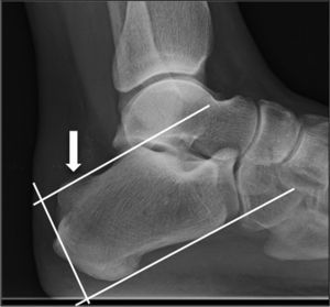 Lateral radiograph of ankle. The arrow signals the posterosuperior exostosis of the calcaneus, which exceeds the upper line in the parallel pitch line method and, thus, the cause is considered to be Haglund