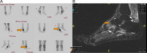 (A) Bone scintigraphy using 99mTc, which reveals a severe lesion in the naviculocuneiform region of right tarsus. (B) Sagittal magnetic resonance imaging in short tau inversion recovery (STIR) sequences with an increased signal intensity. More evident at the intermediate cuneiform level and right lateral region.
