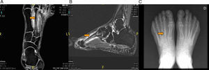 (A) Coronal magnetic resonance imaging (MRI), with fat saturation, showing bone edema in diaphysis of the second metatarsal of left foot, and in neighboring soft tissue. (B) Sagittal MRI of left foot in short tau inversion recovery (STIR) sequence showing bone edema in diaphysis of the second metatarsal, and in neighboring soft tissue. (C) Plain radiography showing the image of the fracture callus in the diaphysis of the second metatarsal of left foot.