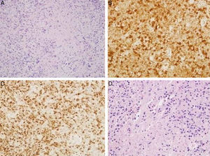(A) Hematoxylin-eosin: cervical lymph node. Lymphocytes with areas of necrosis at different stages of maturation. (B) Cervical lymph node. Presence of lymphocytes expressing CD8 in relation to areas of necrosis. (C) Cervical lymph node. Presence of lymphocytes expressing TIA1 in relation to the areas of necrosis. (D) Supraclavicular lymph node. Hematoxylin-eosin: lymphocytes with areas of necrosis at different stages of maturation.