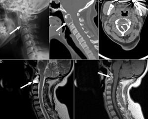 Lateral radiograph of the cervical spine (A) showing an expansile osteolytic lesion in the vertebral body of C2 with cortical insufflation (arrow). Sagittal (B) and axial (C) planes in cervical spinal computed tomography showing that the lesion totally replaced the bone marrow (arrow) and interrupted the cortical at the right posterolateral surface of the vertebral body (arrow). Sagittal view in T2-weighted sequences (D) and in T1 after gadolinium enhancement (E) in magnetic resonance imaging of the cervical spine, which showed a cystic area, necrosis and trabeculation. The lesion was markedly hyperintense in T2 and hypointense in T1, showing peripheral enhancement after the administration of gadolinium (arrows).
