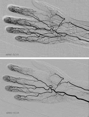 Occlusion of right radial artery at the level of the anatomical snuffbox.