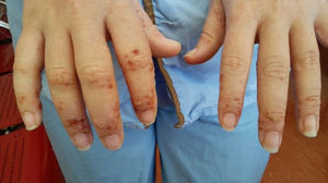 Diffuse pustular lesions on the dorsum of the hands.