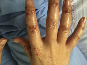 Diffuse pustular lesions on the dorsum of the hands.
