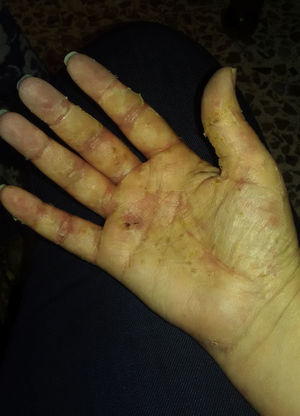 Resolution of pustular lesions on the palms of the hands (scaling phase).