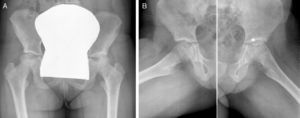 Anteroposterior (Panel A) and frog-leg lateral (Panel B) radiographs of the pelvis showing left hip joint space narrowing, subchondral cysts of the left femoral head and acetabular sclerosis (*).