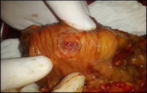 Image of intestinal perforation in a patient with Behçet's disease.