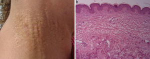 (a) Yellowish papular lesions looking like “goosebumps” in right neck region, surrounded by normal skin. (b) Hematoxylin-eosin staining: sample of calcified elastic fibers in reticular dermis.