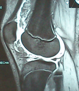 Sagittal views; T2-weighted with contrast. Intra-articular fluid. Synovial hypertrophy with hyperintense areas that correspond to fat.