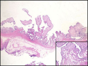 Villous proliferation in the synovium. Inset: adipose infiltration.