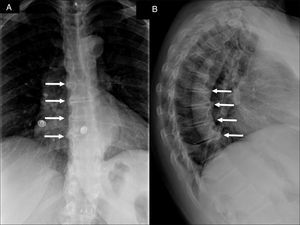 Anteroposterior (A) and lateral (B) radiographs of thoracic spine showing the bone bridges in right anterolateral aspect of 4 contiguous vertebral bodies (white arrows) consistent with the diagnosis of diffuse idiopathic skeletal hyperostosis (DISH). The lateral radiograph also reveals that these bone bridges form angles of more than 45° with the vertebral border.