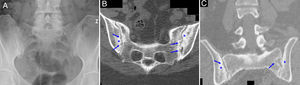 Radiograph of pelvis (A) showing sclerosis, joint space narrowing and erosions in right sacroiliac joint and sclerosis and pseudo-widening on the left (bilateral grade 3 sacroiliitis). Computed tomography of sacroiliac joints showing axial (B) and coronal (C) planes with areas of sclerosis (asterisks) and erosions (arrows) in both joint margins.