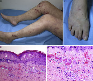 (a) Livedo reticularis in its variant, livedo racemose, involving both lower limbs in their entirety. (b) Purpuric discoloration on the second toe. (c) Skin displayed epidermal necrosis and the presence of hyaline thrombi in the papillary dermal vessels (hematoxylin–eosin, 100×). (d) Greater detail of the thrombi (hematoxylin–eosin, 20×).