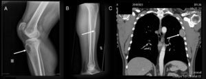 (A) Nonossifying fibroma in right anterior tibial tuberosity. (B) Nonossifying fibroma in middle third of left tibia. (C) Chest computed tomography with lytic lesion growing toward the pleura with a diameter of 5cm in left 5th rib.