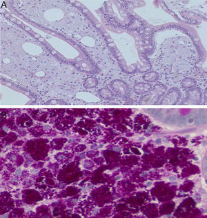 Small bowel (duodenal) biopsy. (A) Intestinal villi with expansion of the lamina propria by numerous pink-colored foamy macrophages (hematoxylin & eosin 20×). Occasional “empty spaces” correspond to extracellular lipid deposits. (B) Macrophages loaded with periodic acid Schiff (PAS)-diastase-positive intracytoplasmic granules (20–40×).