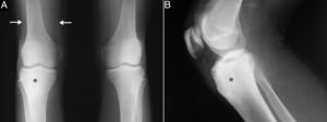 Anteroposterior radiographs of both knees (A) and lateral view of right knee (B) showing sclerosis in upper third of right tibia (asterisks) with no apparent “nidus”, and a reduction in the volume of the distal third of the quadriceps due to muscle atrophy (arrows).