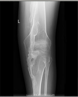 Radiograph of left knee showing ankylosis secondary to bone bridges.