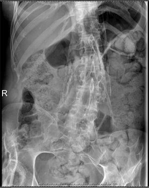 Radiograph of abdomen showing paravertebral bone bridges that are also seen in right hip.
