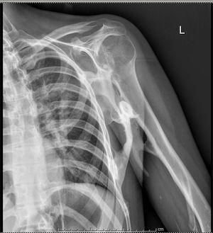 Radiograph of shoulder showing a well-defined plaque of mature bone between the chest wall, humerus and scapula.