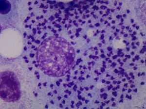 Phagocytic mononuclear cells (macrophages) with abundant parasitic inclusions compatible with leishmaniasis.