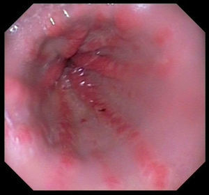 Endoscopic images of gastric antral vascular ectasia.