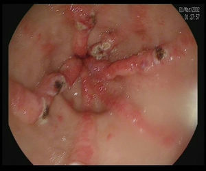 Endoscopic image of vascular ectasia treated with argon plasma coagulation.