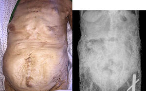 Calcinosis universalis in abdomen and pelvis.