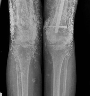 Calcinosis in thighs with intramuscular calcification proximal to the distal insertion of the vastus medialis. Intramedullary nail secondary to femoral fracture.