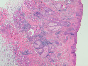 Histological image of a skin biopsy. The interstitial lymphohistiocytic infiltrate can be observed in superficial and deep dermis, with the presence of mucin deposits surrounding the collagen fibers. Histopathological view of interstitial granulomatous dermatitis.