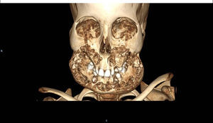 3D-reconstruction of patient lesions.