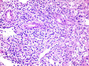 Piecemeal necrosis with damage to the hepatocytes. Necroinflammatory lesion.