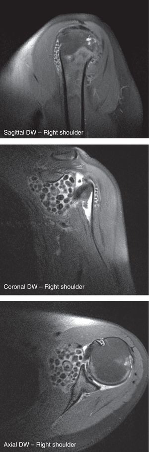 Magnetic resonance imaging was employed to acquire turbo spin echo diffusion weighted (DW) sequences with fat saturation that effectively demonstrated the anatomy of the shoulder joint and the presence of loose bodies previously identified in radiographs and ultrasound images. They had a characteristic behavior, with areas of lower signal intensity in the center than in the periphery, because of the calcification of the chondral bodies.
