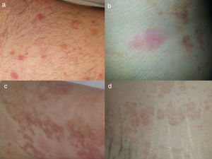 Urticarial vasculitis. The 4 patients had undergone a biopsy that confirmed the diagnosis of leukocytoclastic vasculitis. Note the presence of acute urticaria-like wheals and lesions in resolution with purpura (a–d).