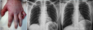 (A) Edema and urticaria in the patient's left hand and flexion of the fifth finger produced by involvement of the ulnar nerve. (B) Chest radiograph during exhalation. (C) Chest radiograph during inhalation showing hemiplegia affecting left hemidiaphragm.