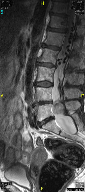 Sagittal T2-weighted turbo spin-echo image. Wide spinal canal with dilation of the dural sac termination that occupies the entire canal at the level of L5. Above that, note “flow voids” corresponding to dilated intradural vascular structures.