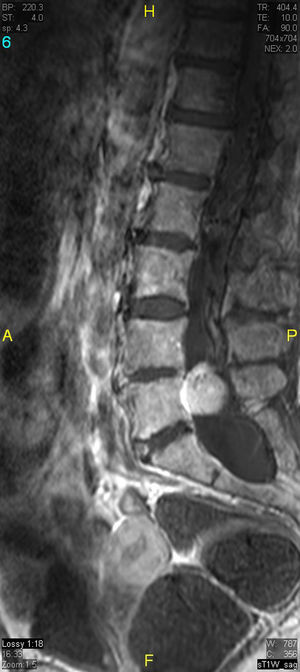 Contrast-enhanced sagittal T1-weighted turbo spin-echo image. Intense enhancement of the intradural mass.