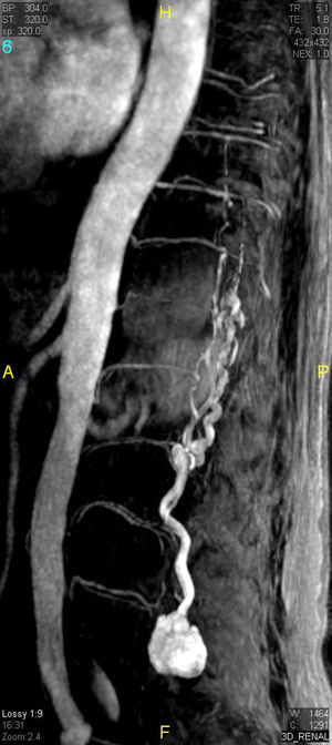 Contrast-enhanced magnetic resonance angiographic image. Sagittal plane with maximum intensity projection reconstruction. The image shows the mass, as well as the dilated vascular structures. Because of the static nature of the examination, the view does not show the origin of the blood supply.