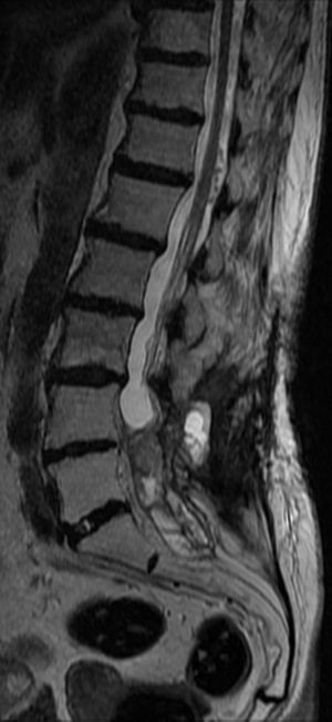 Sagittal T2-weighted turbo spin-echo magnetic resonance image. Reduction of the intradural mass and absence of the dilated vascular structures.