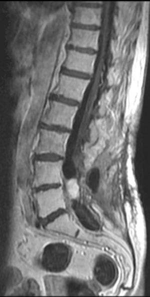 Contrast-enhanced sagittal T1-weighted turbo spin-echo image. Reduction of the intradural mass and absence of the dilated vascular structures.