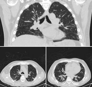 High-resolution computed tomography of the chest, showing interstitial involvement with a pattern of irregular septal thickening and areas of alveolar filling with air bronchogram in peripherally distributed patches (pattern of organizing pneumonia).