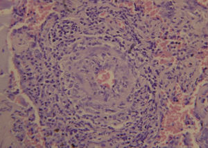 Histopathological study of the lung specimen demonstrates small-vessel vasculitis with extensive areas of fibrosis and pulmonary emphysema.