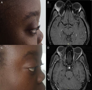 (A) Right proptosis at the onset of the clinical symptoms. (B) T1-weighted postcontrast cross-sectional magnetic resonance image (MRI) at admission. Note the enlargement of right lacrimal gland, with enhancement after the administration of contrast medium. (C) Decrease in proptosis after 1 year of follow-up. (D) T1-weighted postcontrast cross-sectional MRI after 1 year of follow-up. Note the decrease in the size of right lacrimal gland versus baseline MRI.