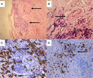 Lacrimal gland biopsy. Hematoxylin–eosin staining: (A) Storiform fibrosis, stromal sclerosis and chronic inflammatory infiltrate (×10); (B) Veins with walls swollen with the infiltration of mononuclear inflammatory cells causing obliteration of the lumen. Immunohistochemical staining (×40). (C) Extensive infiltration of plasma cells expressing CD (cluster of differentiation) 38 (anti-CD38 with 3,3′-diaminobenzidine [DAB] staining, ×40); (D) IgG4-positive plasma cells (anti-IgG4 DAB staining, ×40).